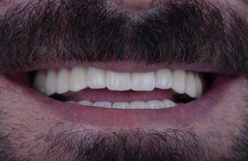 implant üstü zirconya 